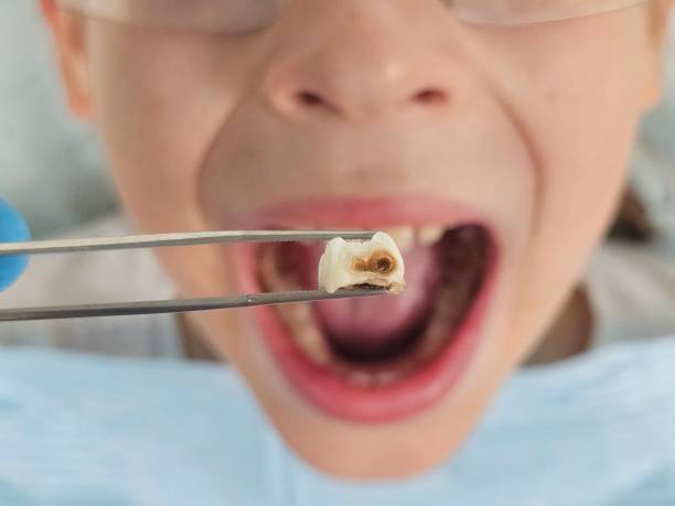 Best Emergency Cosmetic Dentistry (e.g., broken veneers) in Parker City, IN